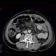 Necrosis of descending colon, colostomy: CT - Computed tomography