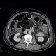 Necrosis of descending colon, colostomy: CT - Computed tomography