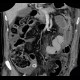 Necrosis of descending colon, colostomy: CT - Computed tomography