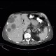 Carcinoma of bladder, metastasis in liver and abdominal wall, necrotic metastasis: CT - Computed tomography