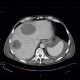 Carcinoma of bladder, metastasis in liver and abdominal wall, necrotic metastasis: CT - Computed tomography