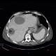 Carcinoma of bladder, metastasis in liver and abdominal wall, necrotic metastasis: CT - Computed tomography