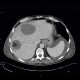 Carcinoma of bladder, metastasis in liver and abdominal wall, necrotic metastasis: CT - Computed tomography