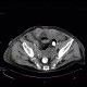 Carcinoma of bladder, metastasis in liver and abdominal wall, necrotic metastasis: CT - Computed tomography