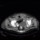 Carcinoma of bladder, metastasis in liver and abdominal wall, necrotic metastasis: CT - Computed tomography