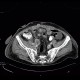 Carcinoma of bladder, metastasis in liver and abdominal wall, necrotic metastasis: CT - Computed tomography