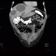 Carcinoma of bladder, metastasis in liver and abdominal wall, necrotic metastasis: CT - Computed tomography