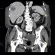 Carcinoma of bladder, metastasis in liver and abdominal wall, necrotic metastasis: CT - Computed tomography