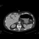 Necrotizing enterocolitis, gas in portal vein: CT - Computed tomography