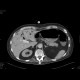 Necrotizing enterocolitis, gas in portal vein: CT - Computed tomography