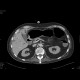 Necrotizing enterocolitis, gas in portal vein: CT - Computed tomography