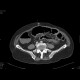 Necrotizing enterocolitis, gas in portal vein: CT - Computed tomography