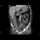 Necrotizing enterocolitis, gas in portal vein: CT - Computed tomography