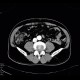 AV fistula, arteriovenous fistula in the leg: CT - Computed tomography