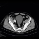 AV fistula, arteriovenous fistula in the leg: CT - Computed tomography