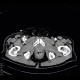 AV fistula, arteriovenous fistula in the leg: CT - Computed tomography