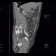 AV fistula, arteriovenous fistula in the leg: CT - Computed tomography