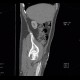 AV fistula, arteriovenous fistula in the leg: CT - Computed tomography