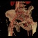 AV fistula, arteriovenous fistula in the leg: CT - Computed tomography