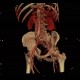 AV fistula, arteriovenous fistula in the leg: CT - Computed tomography