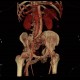 AV fistula, arteriovenous fistula in the leg: CT - Computed tomography