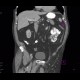 Unknown pathology, secondary finding, small bowel: CT - Computed tomography