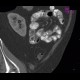 Unknown pathology, secondary finding, small bowel: CT - Computed tomography