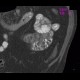 Unknown pathology, secondary finding, small bowel: CT - Computed tomography