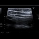 Appendix, normal appearance: US - Ultrasound