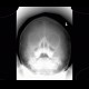 Development of paranasal sinuses, six years, Waters view: X-ray - Plain radiograph