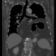 Hiatal hernia, upside-down stomach: CT - Computed tomography