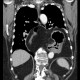 Hiatal hernia, upside-down stomach: CT - Computed tomography