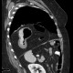Hiatal hernia, upside-down stomach: CT - Computed tomography
