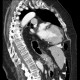 Hiatal hernia, upside-down stomach: CT - Computed tomography