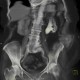 Staghorn calculus, casting stone, nephrolithiasis, VRT: CT - Computed tomography