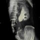 Staghorn calculus, casting stone, nephrolithiasis, VRT: CT - Computed tomography