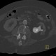 Staghorn calculus, casting stone, nephrolithiasis, VRT: CT - Computed tomography