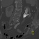 Staghorn calculus, casting stone, nephrolithiasis, VRT: CT - Computed tomography