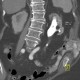 Staghorn calculus, casting stone, nephrolithiasis, VRT: CT - Computed tomography