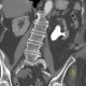 Staghorn calculus, casting stone, nephrolithiasis, VRT: CT - Computed tomography