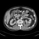 Renal tumour, oncocytoma: CT - Computed tomography