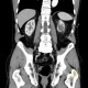 Renal tumour, oncocytoma: CT - Computed tomography