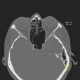 Onodi cell: CT - Computed tomography