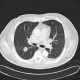 Loculated effusion: CT - Computed tomography