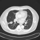 Loculated effusion: CT - Computed tomography