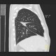 Loculated effusion: CT - Computed tomography