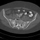 Stress fracture of sacrum: CT - Computed tomography