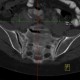 Stress fracture of sacrum: CT - Computed tomography