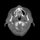 Sequestrum, osteomyelitis of upper jaw, maxilla: CT - Computed tomography