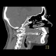 Sequestrum, osteomyelitis of upper jaw, maxilla: CT - Computed tomography